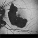 Macular Serpiginous Choroidopathy Macular Serpiginous Choroidopathy